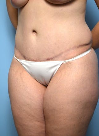 Tummy Tuck Before & After Gallery - Patient 148557 - Image 8