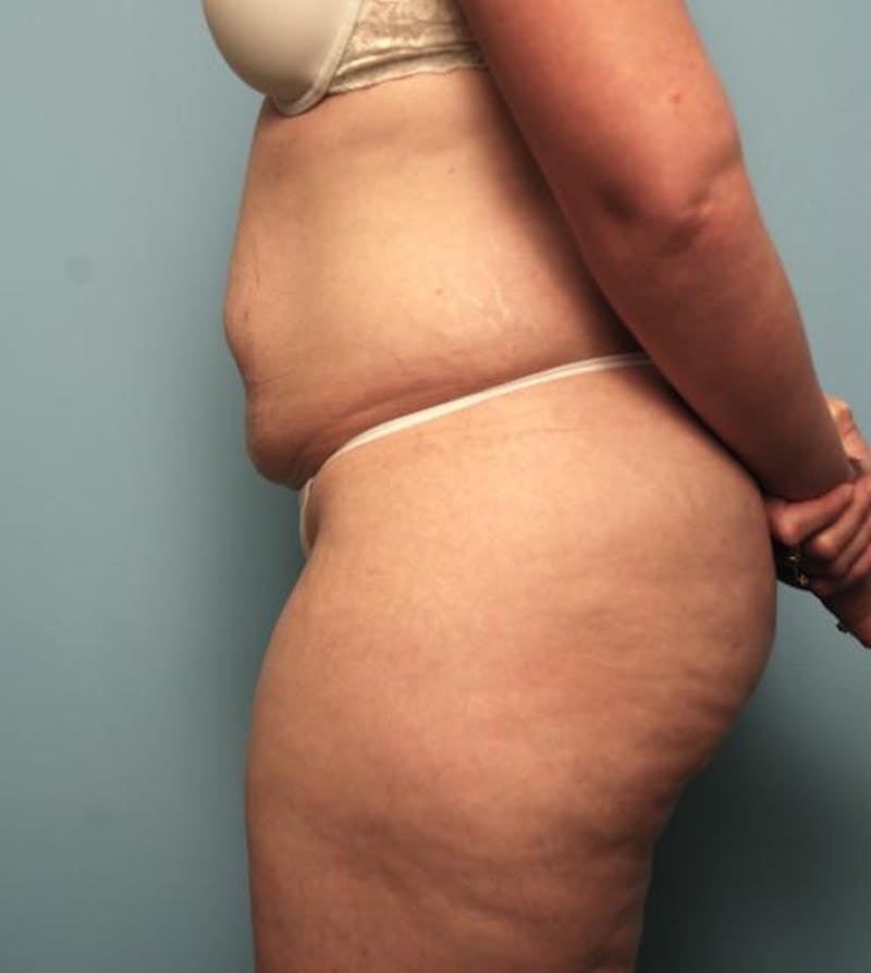 Tummy Tuck Before & After Gallery - Patient 148557 - Image 9