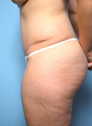 Tummy Tuck Before & After Gallery - Patient 148557 - Image 10