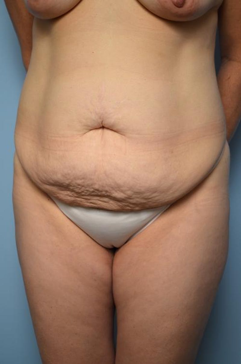 Tummy Tuck Before & After Gallery - Patient 406429 - Image 1