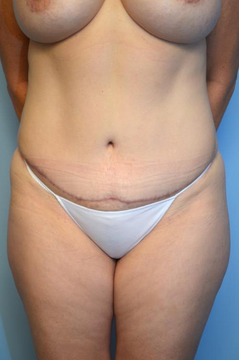 Tummy Tuck Before & After Gallery - Patient 406429 - Image 2