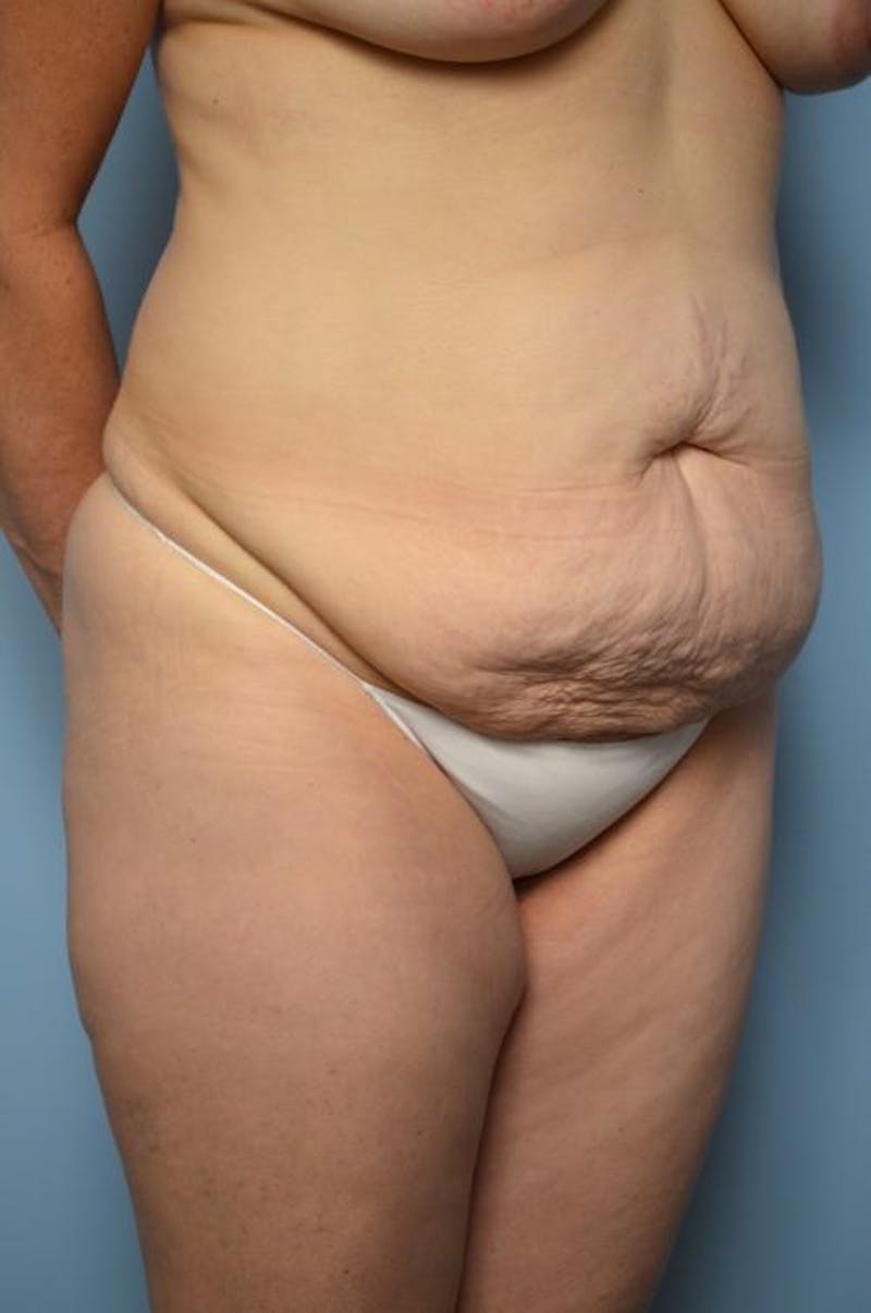 Tummy Tuck Before & After Gallery - Patient 406429 - Image 3