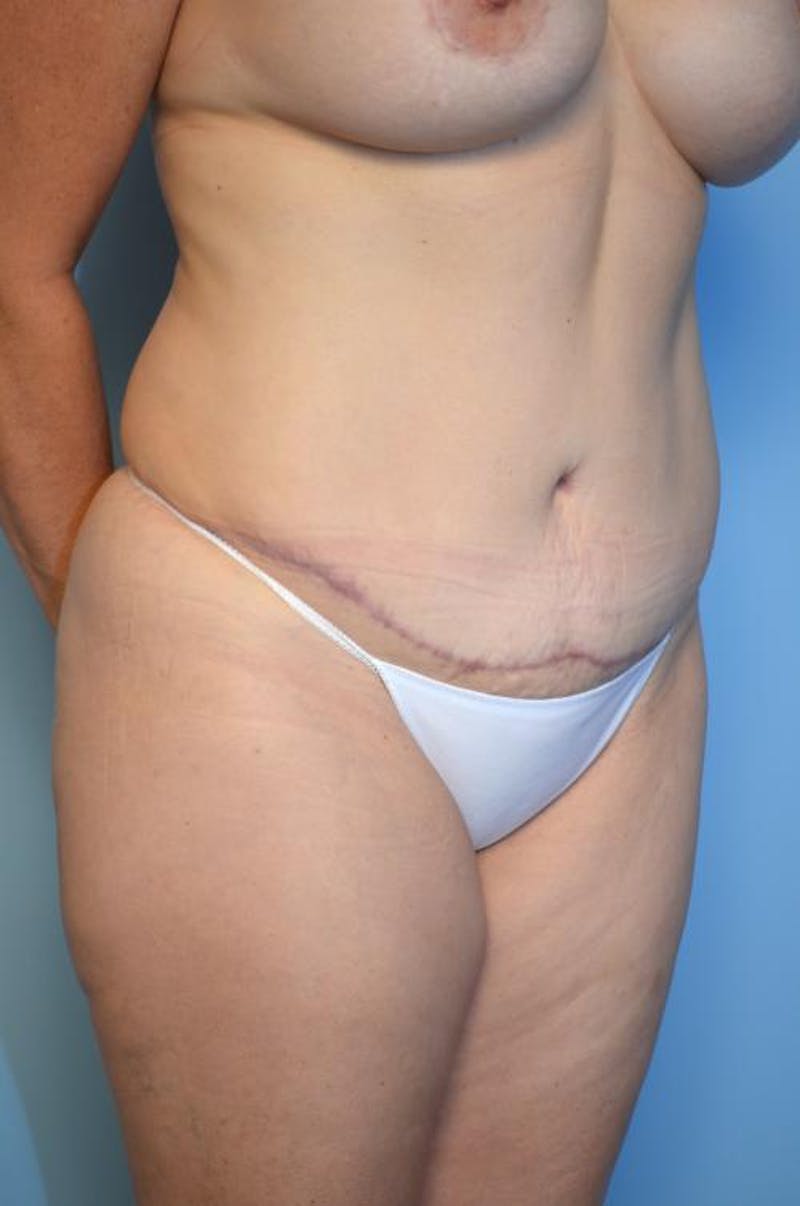 Tummy Tuck Before & After Gallery - Patient 406429 - Image 4