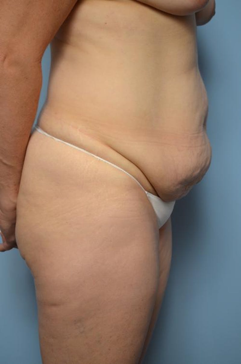 Tummy Tuck Before & After Gallery - Patient 406429 - Image 5