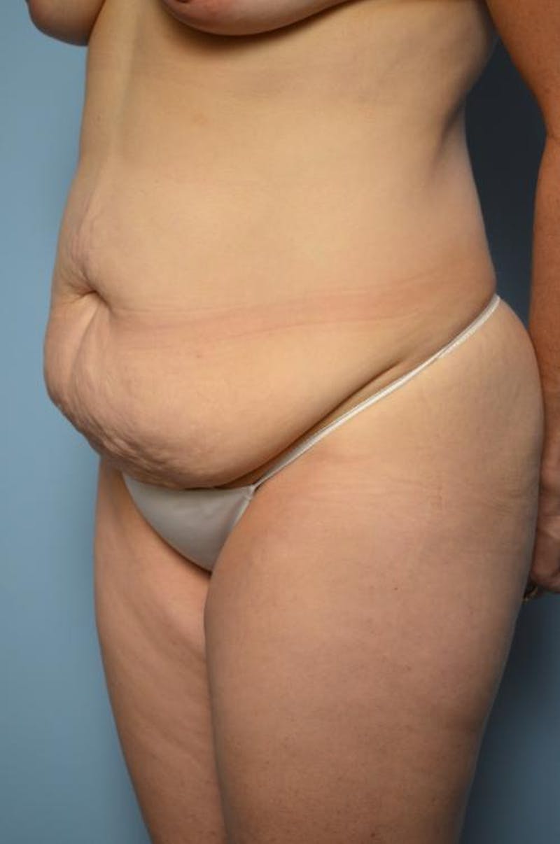 Tummy Tuck Before & After Gallery - Patient 406429 - Image 7