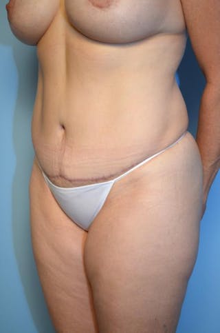 Tummy Tuck Before & After Gallery - Patient 406429 - Image 8