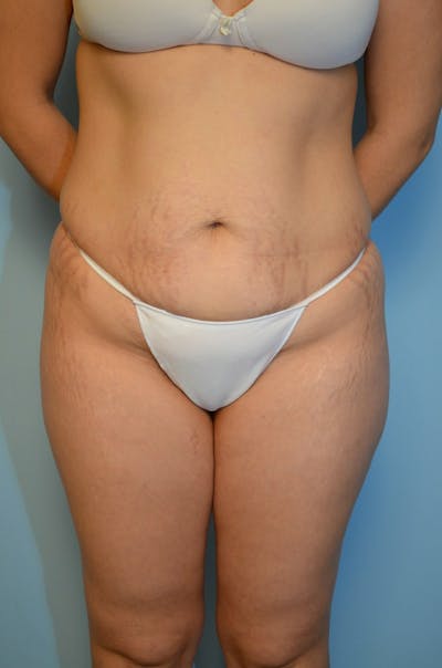Liposuction Before & After Gallery - Patient 289586 - Image 1