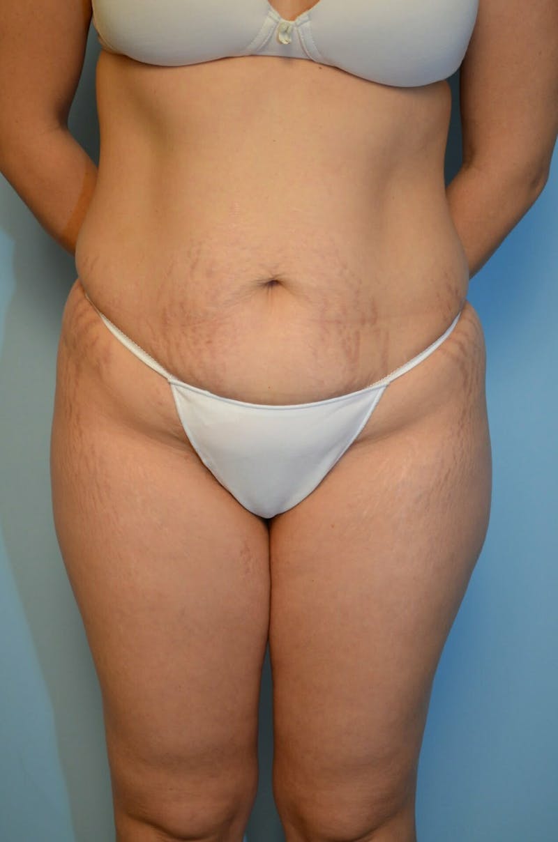 Tummy Tuck Before & After Gallery - Patient 754254 - Image 1