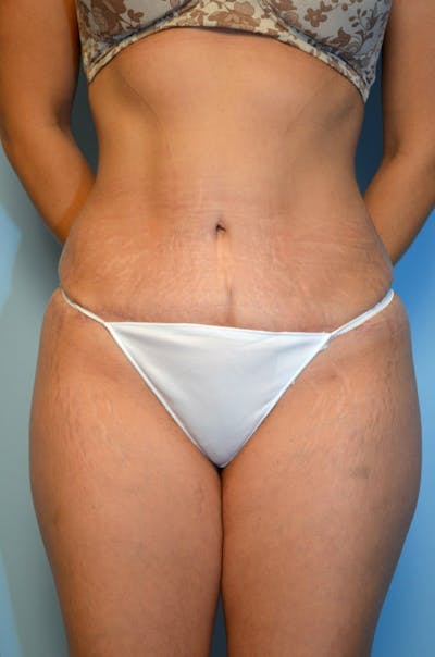 Liposuction Before & After Gallery - Patient 289586 - Image 2