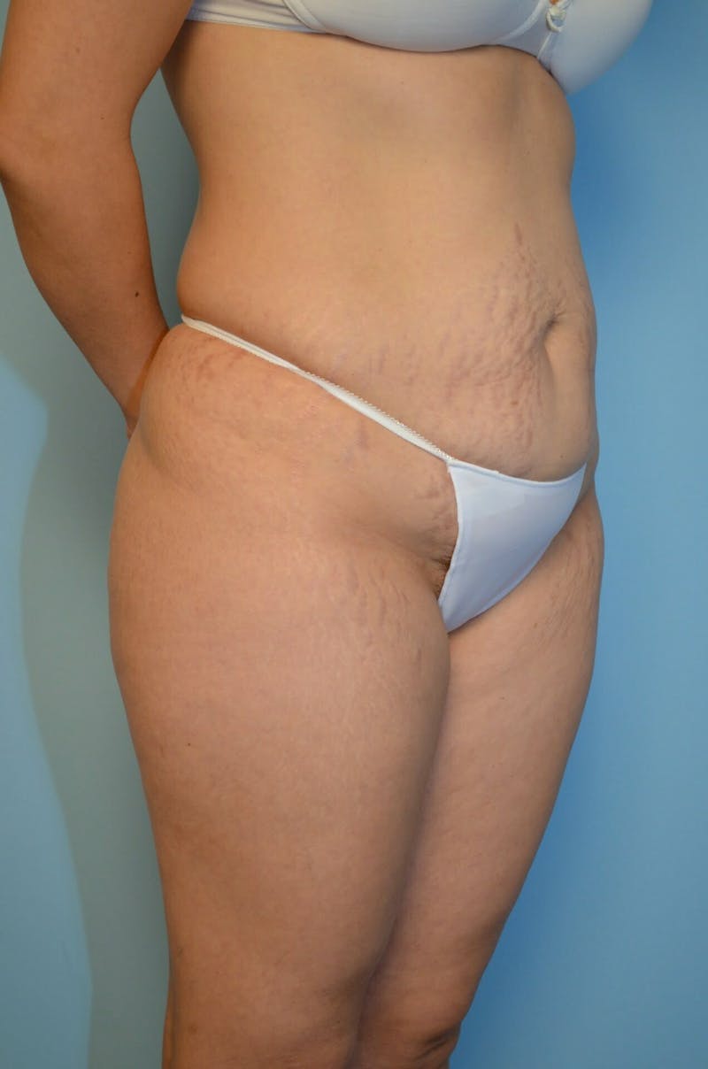 Tummy Tuck Before & After Gallery - Patient 754254 - Image 3