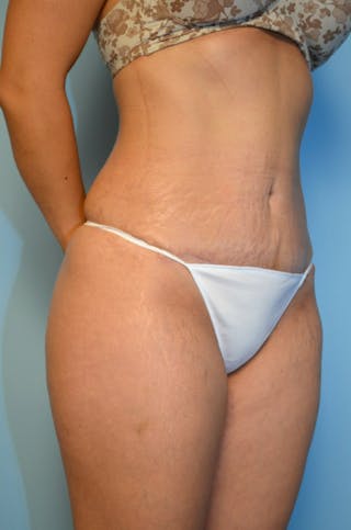 Liposuction Before & After Gallery - Patient 289586 - Image 4
