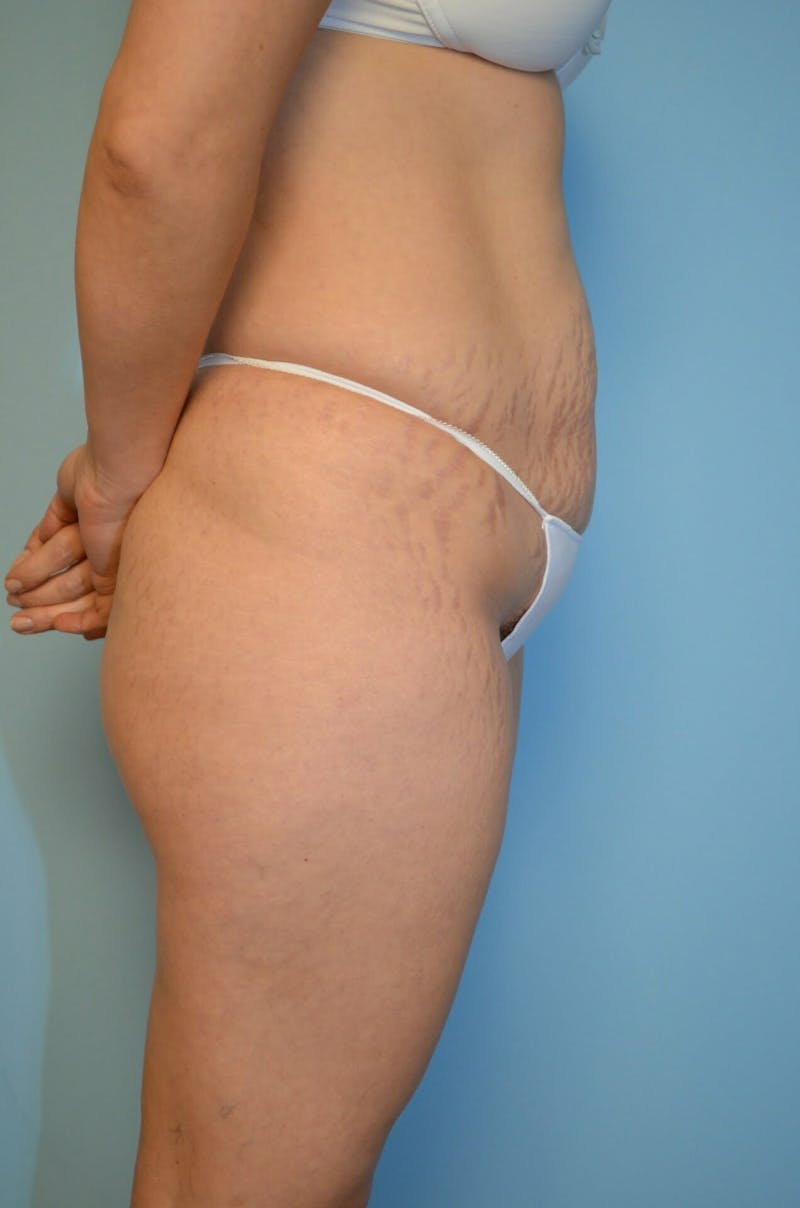 Tummy Tuck Before & After Gallery - Patient 754254 - Image 5