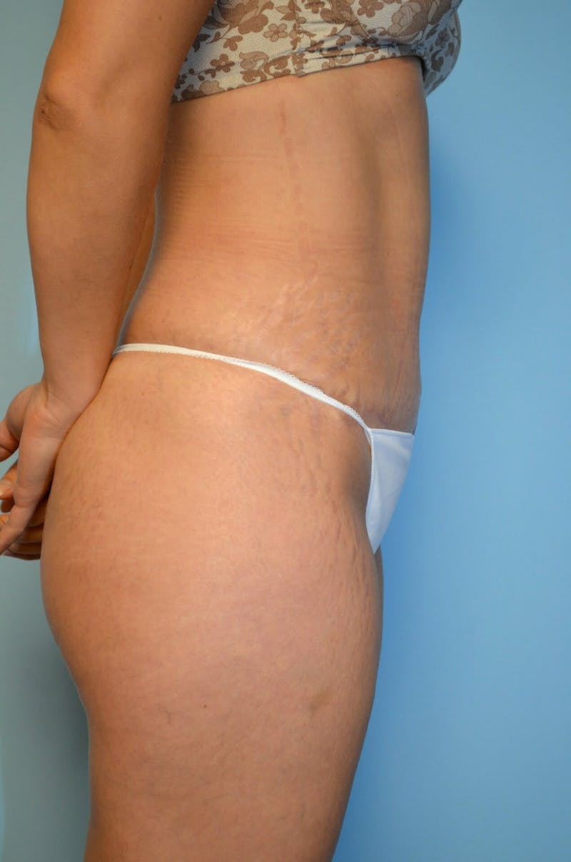Tummy Tuck Before & After Gallery - Patient 754254 - Image 6