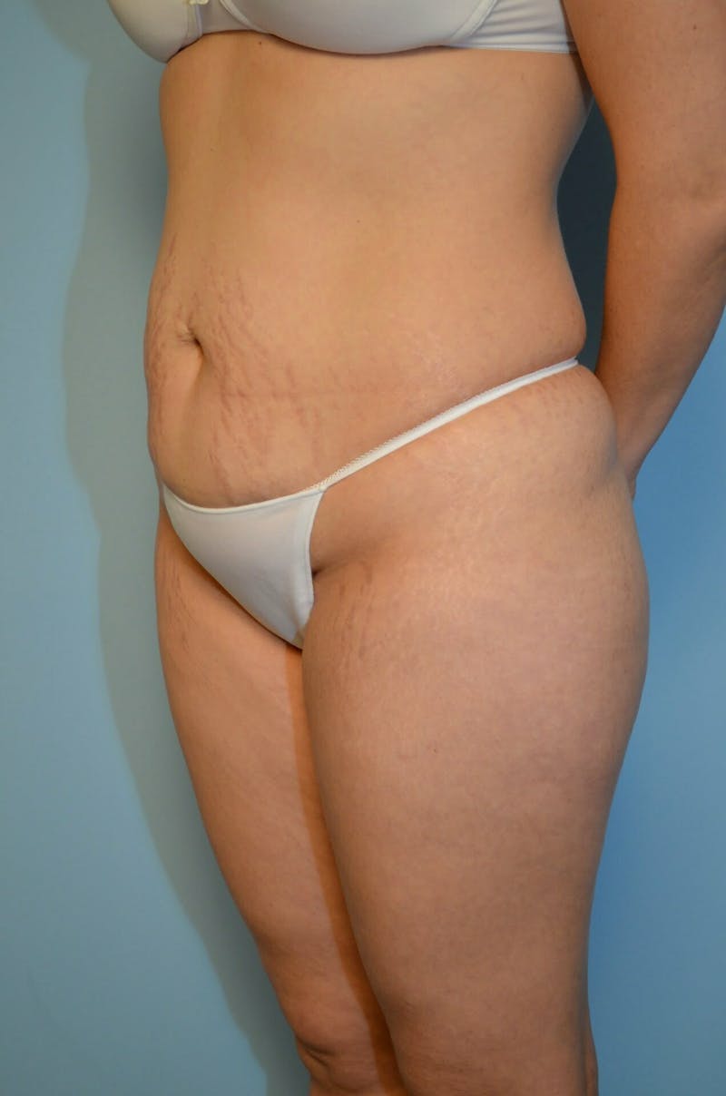 Tummy Tuck Before & After Gallery - Patient 754254 - Image 7