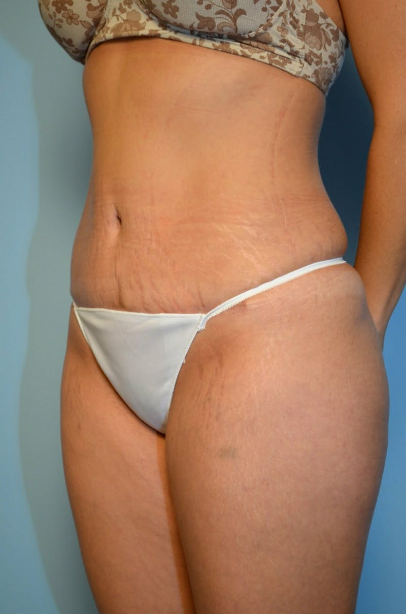 Tummy Tuck Before & After Gallery - Patient 754254 - Image 8