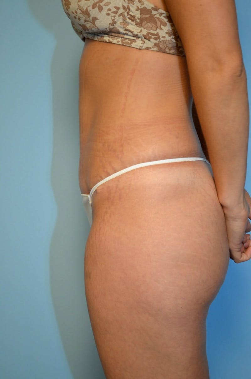 Tummy Tuck Before & After Gallery - Patient 754254 - Image 10