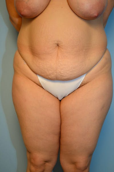 Tummy Tuck Before & After Gallery - Patient 977961 - Image 1