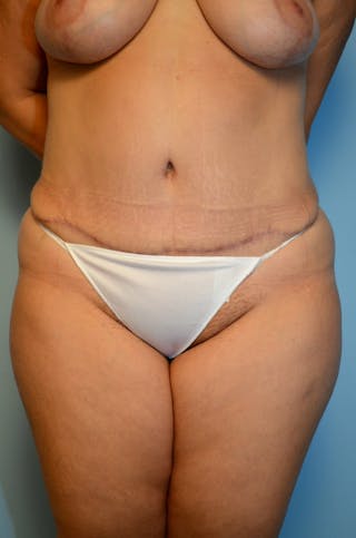 Tummy Tuck Before & After Gallery - Patient 977961 - Image 2