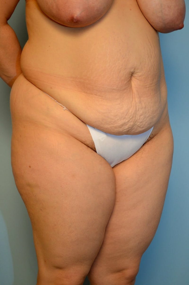 Tummy Tuck Before & After Gallery - Patient 977961 - Image 3