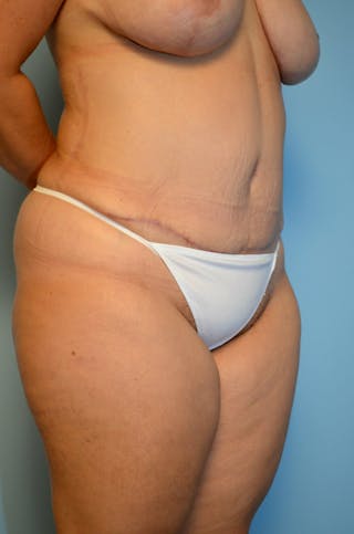 Tummy Tuck Before & After Gallery - Patient 977961 - Image 4