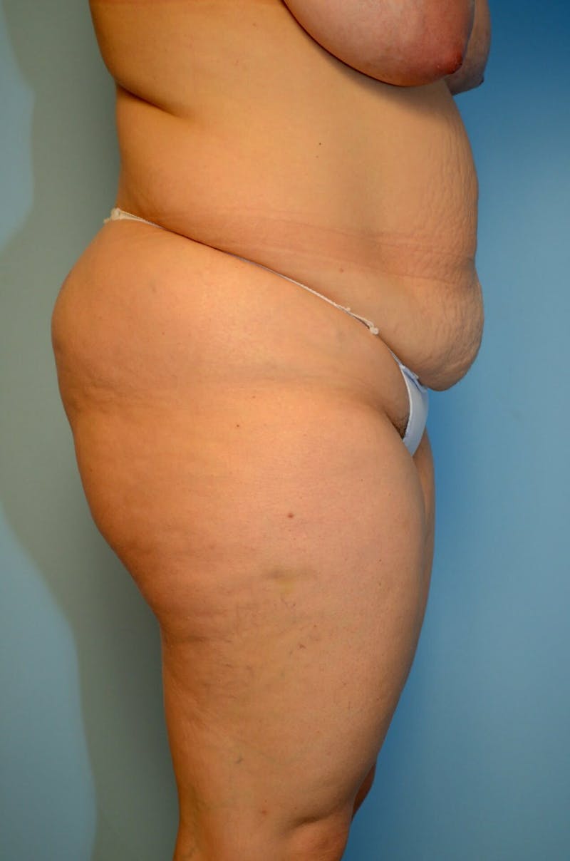 Tummy Tuck Before & After Gallery - Patient 977961 - Image 5