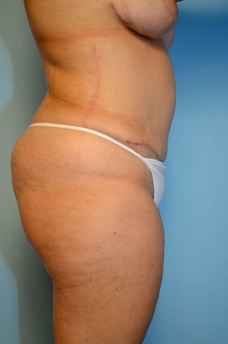 Tummy Tuck Before & After Gallery - Patient 977961 - Image 6