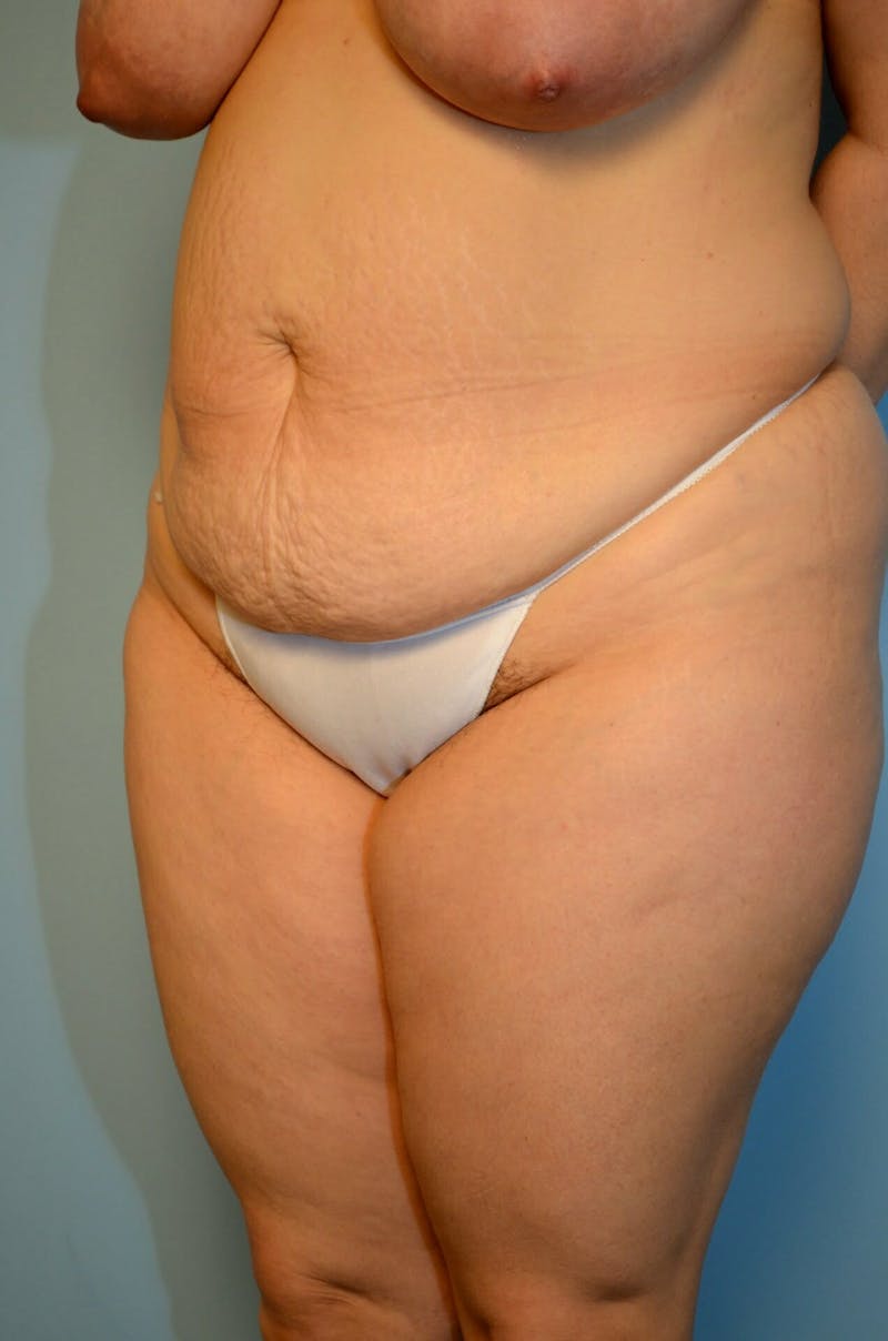 Tummy Tuck Before & After Gallery - Patient 977961 - Image 7