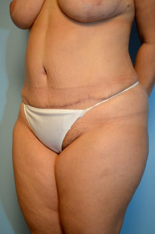 Tummy Tuck Before & After Gallery - Patient 977961 - Image 8