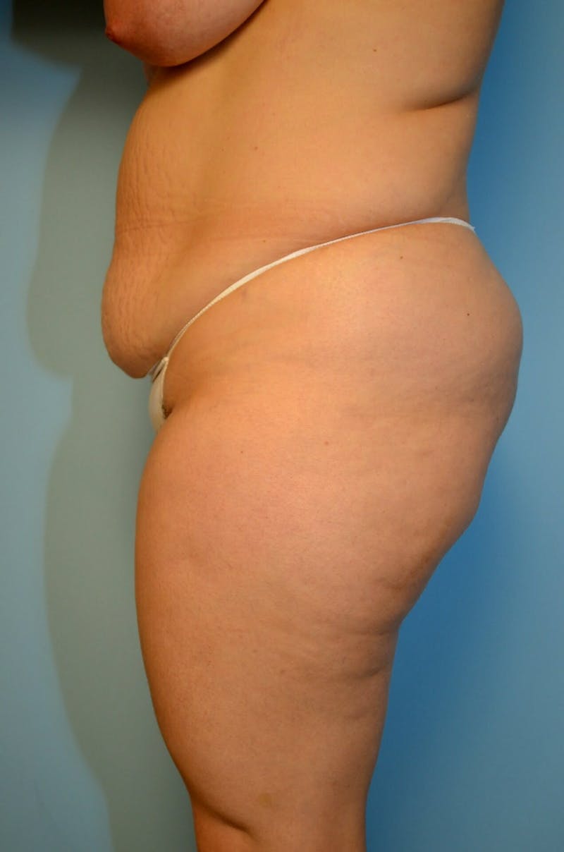 Tummy Tuck Before & After Gallery - Patient 977961 - Image 9