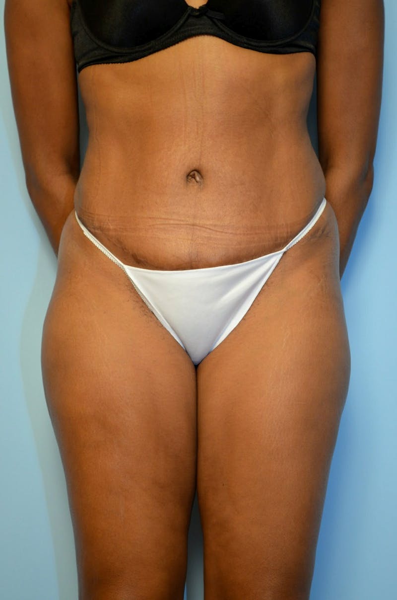 Tummy Tuck Before & After Gallery - Patient 105301 - Image 2