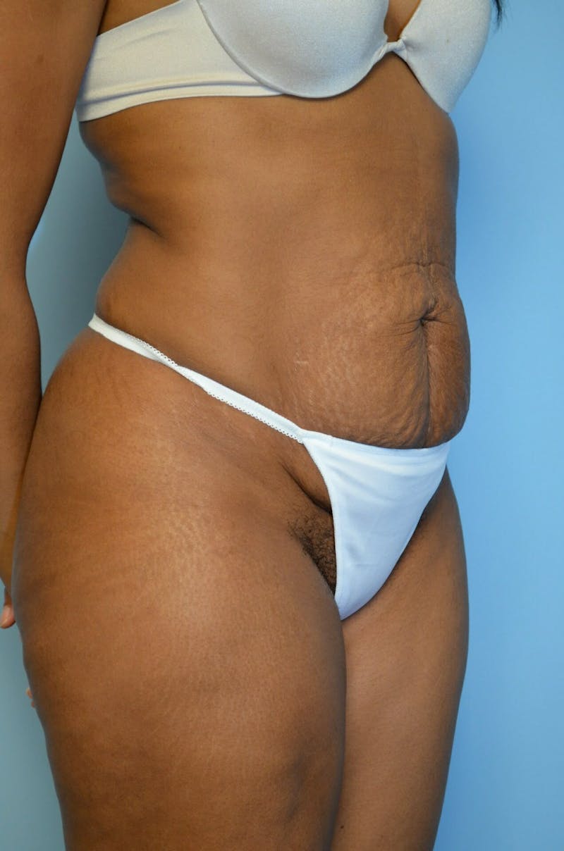 Tummy Tuck Before & After Gallery - Patient 105301 - Image 3