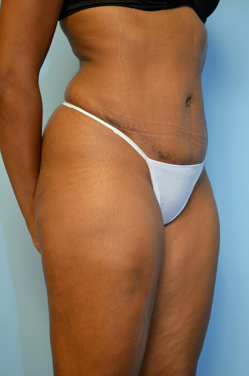Tummy Tuck Before & After Gallery - Patient 105301 - Image 4
