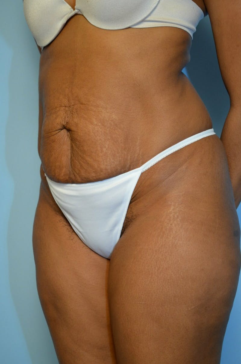 Tummy Tuck Before & After Gallery - Patient 105301 - Image 7