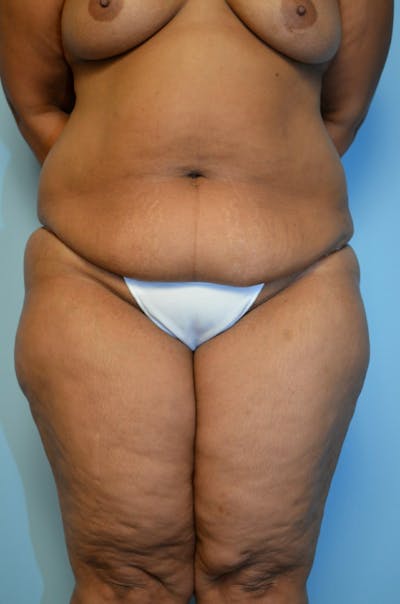 Liposuction Before & After Gallery - Patient 216771 - Image 1