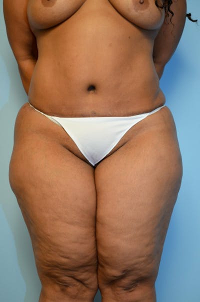 Liposuction Before & After Gallery - Patient 216771 - Image 2