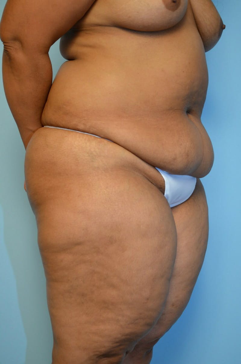 Tummy Tuck Before & After Gallery - Patient 804483 - Image 3