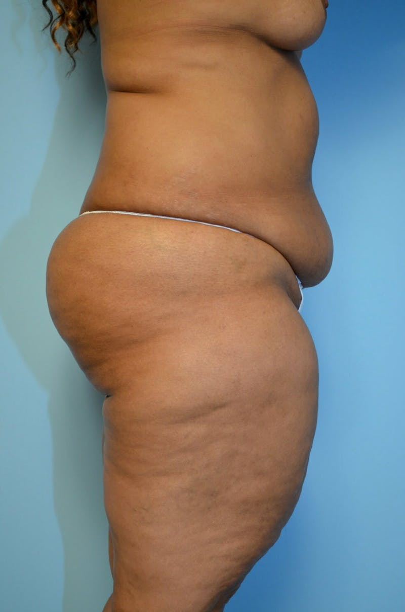 Tummy Tuck Before & After Gallery - Patient 804483 - Image 5
