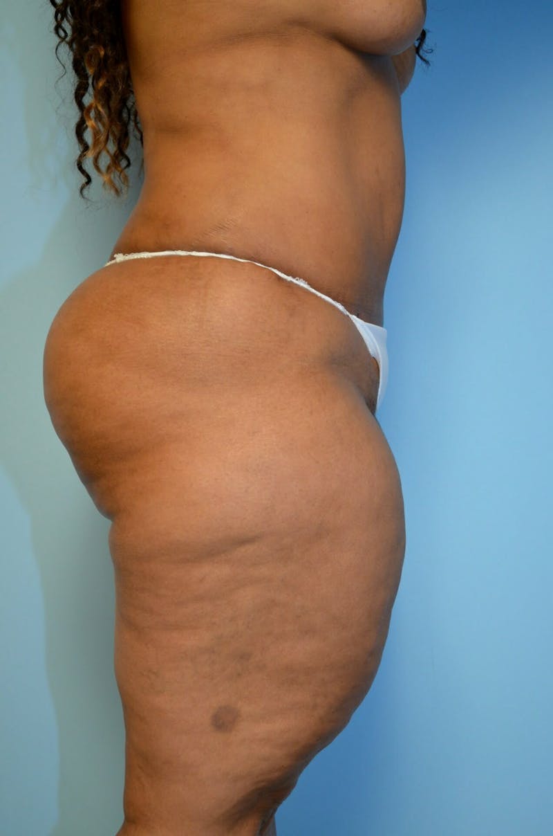 Tummy Tuck Before & After Gallery - Patient 804483 - Image 6