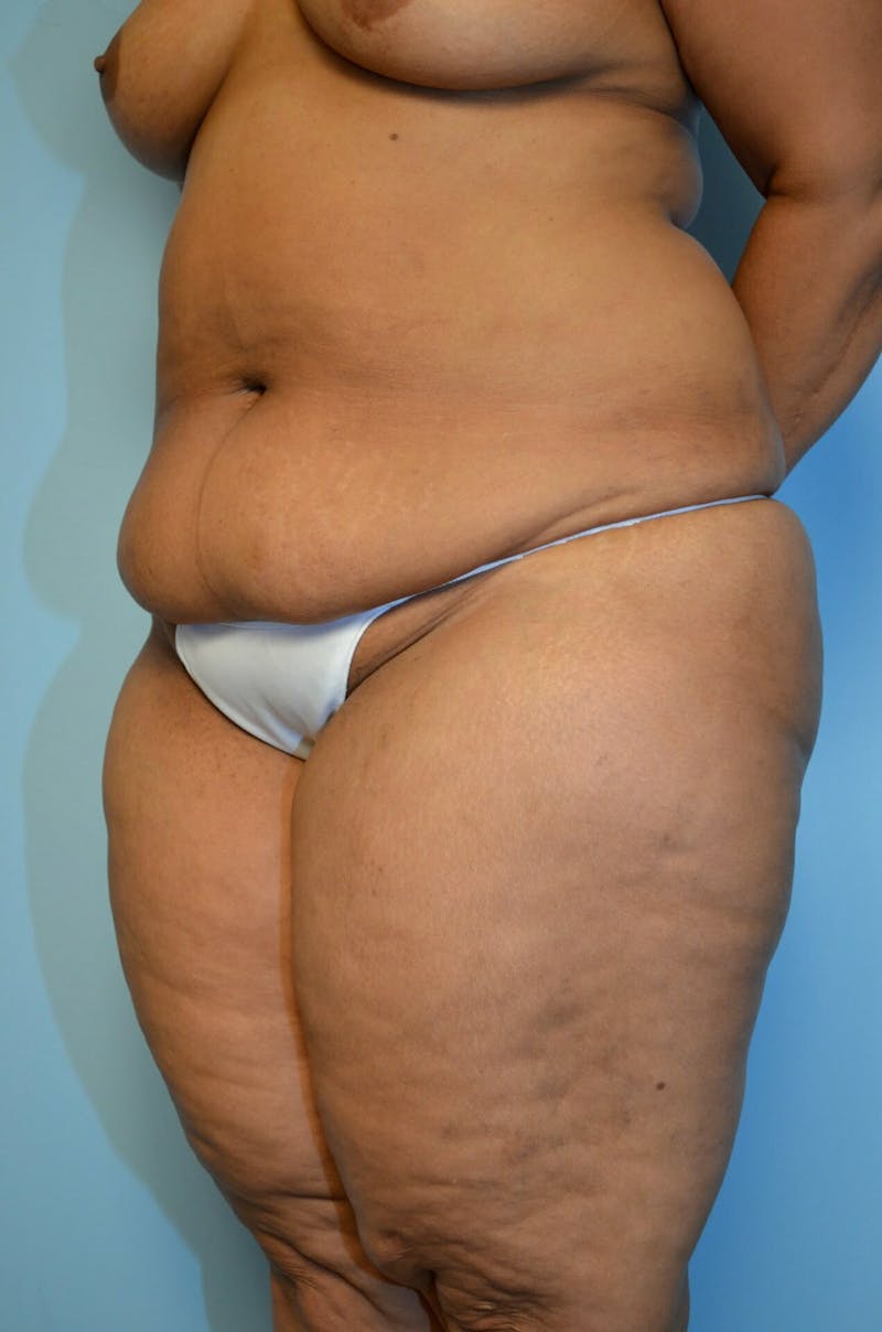 Tummy Tuck Before & After Gallery - Patient 804483 - Image 7