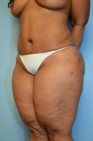 Liposuction Before & After Gallery - Patient 216771 - Image 8