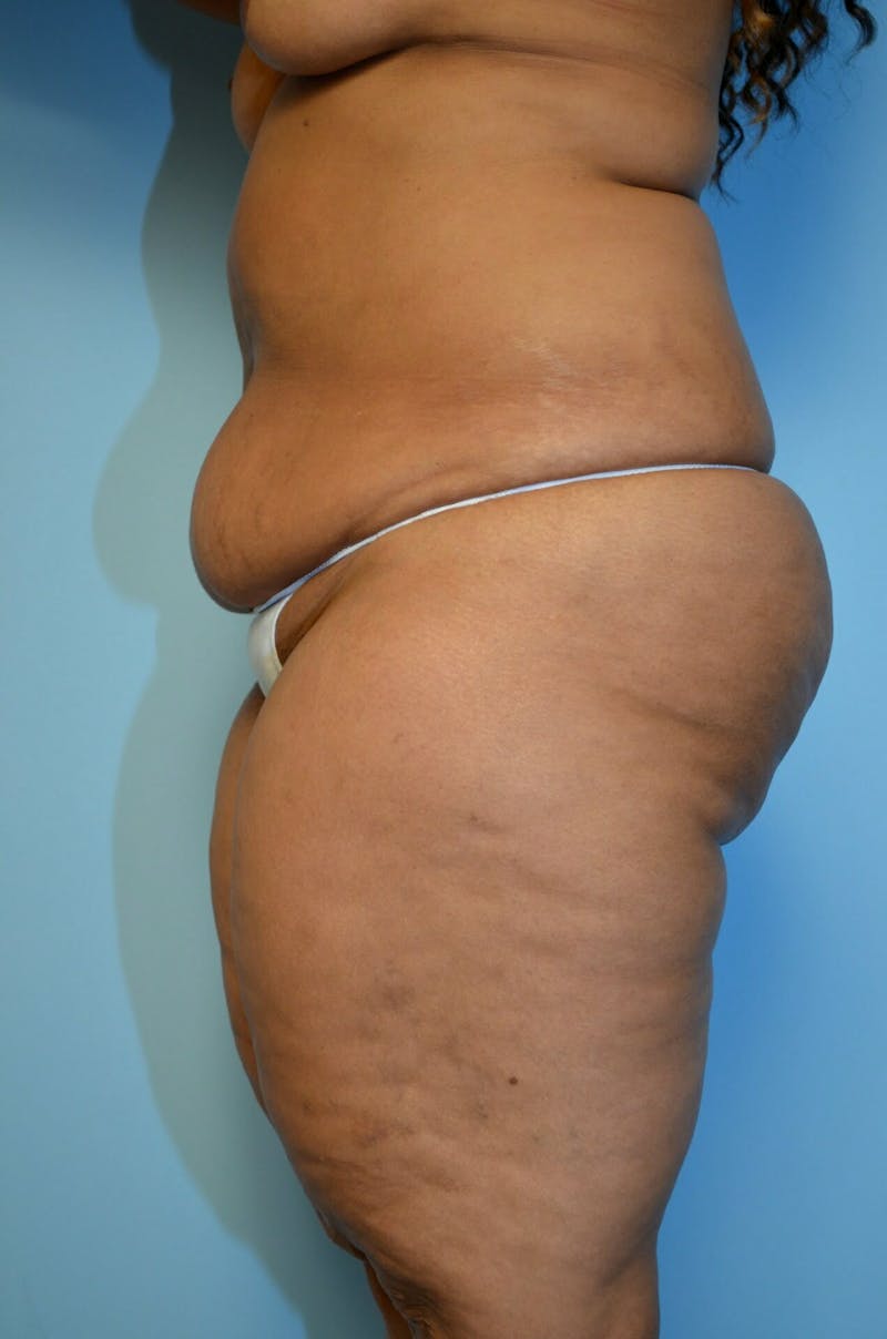 Tummy Tuck Before & After Gallery - Patient 804483 - Image 9