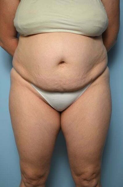 Liposuction Before & After Gallery - Patient 219608 - Image 1