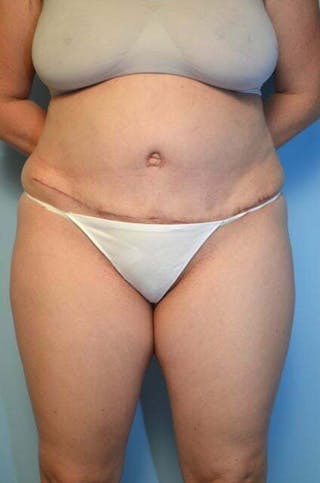 Tummy Tuck Before & After Gallery - Patient 288867 - Image 2