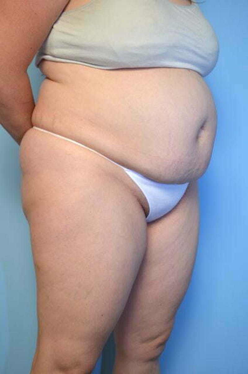 Tummy Tuck Before & After Gallery - Patient 288867 - Image 3