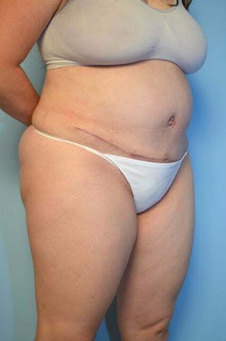 Tummy Tuck Before & After Gallery - Patient 288867 - Image 4