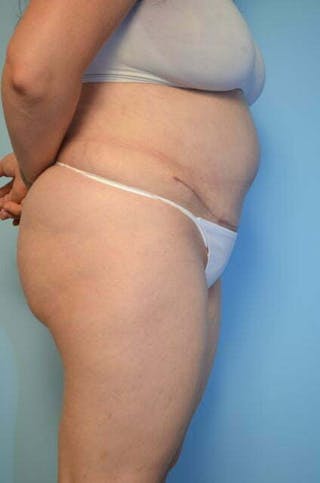 Tummy Tuck Before & After Gallery - Patient 288867 - Image 6