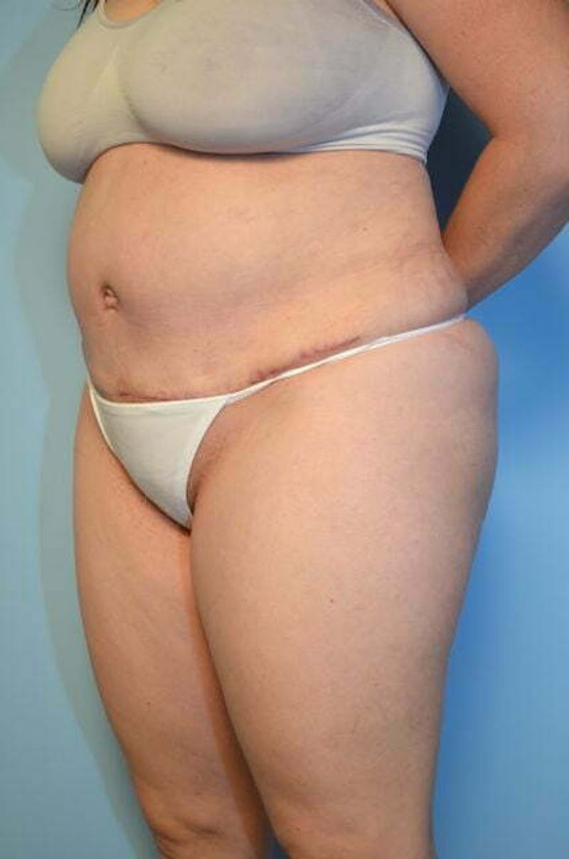 Tummy Tuck Before & After Gallery - Patient 288867 - Image 8