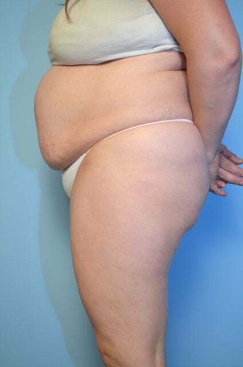 Tummy Tuck Before & After Gallery - Patient 288867 - Image 9