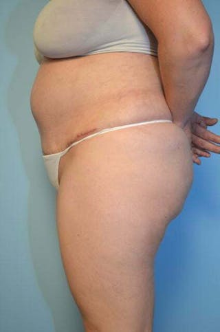 Tummy Tuck Before & After Gallery - Patient 288867 - Image 10