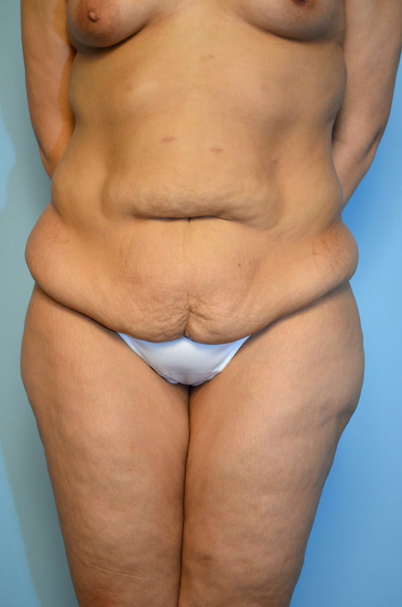 Tummy Tuck Before & After Gallery - Patient 200499 - Image 1